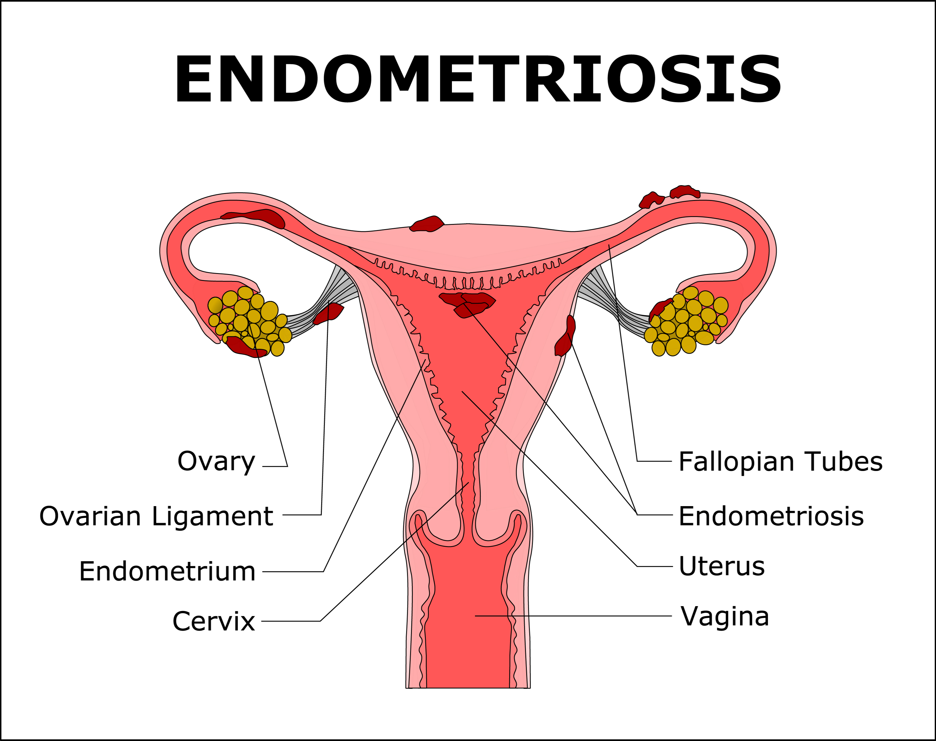 Hilarant D pouiller radiquer Signs Of Blocked Fallopian Tubes Nhs 